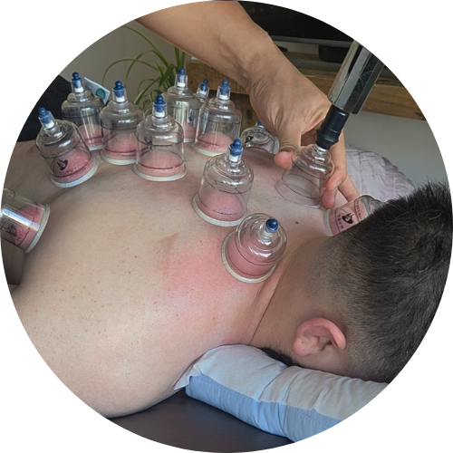 Dry Cupping